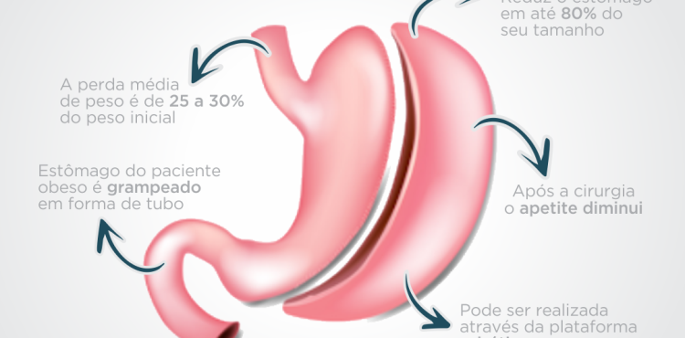 Sleeve Gástrico: O que é e para quem é indicado